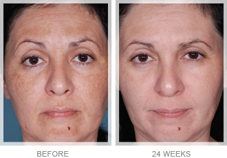 Nu-Derm Before & After *