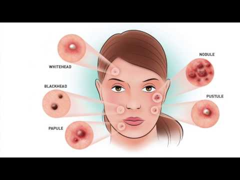 6 Different Types Of Pimples That You Should Know